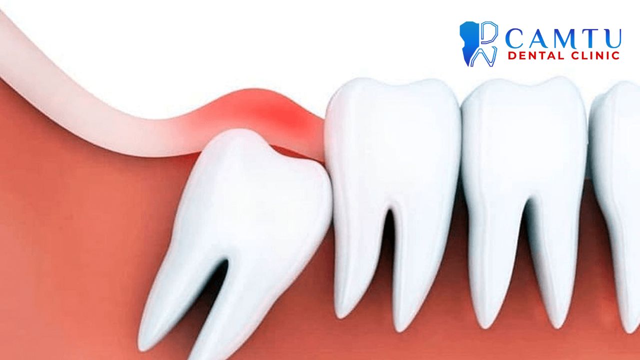 Sưng nướu răng khôn