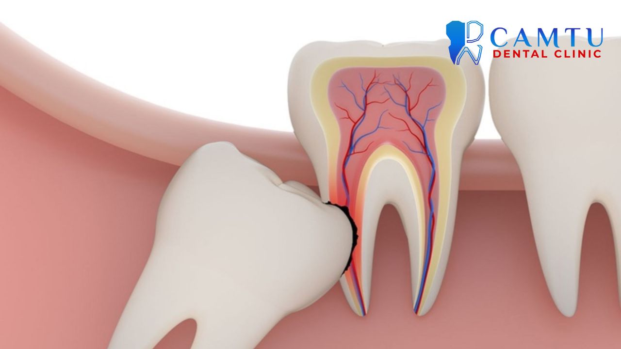 Sưng nướu răng khôn