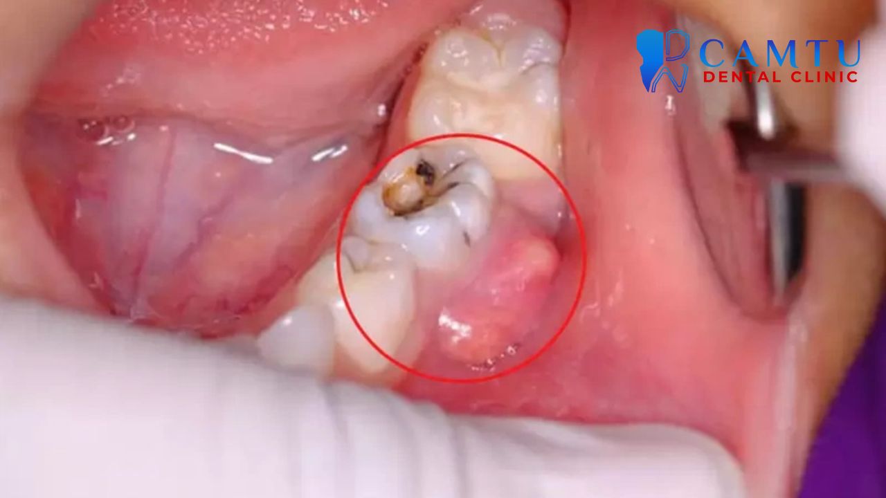 Sưng nướu răng khôn