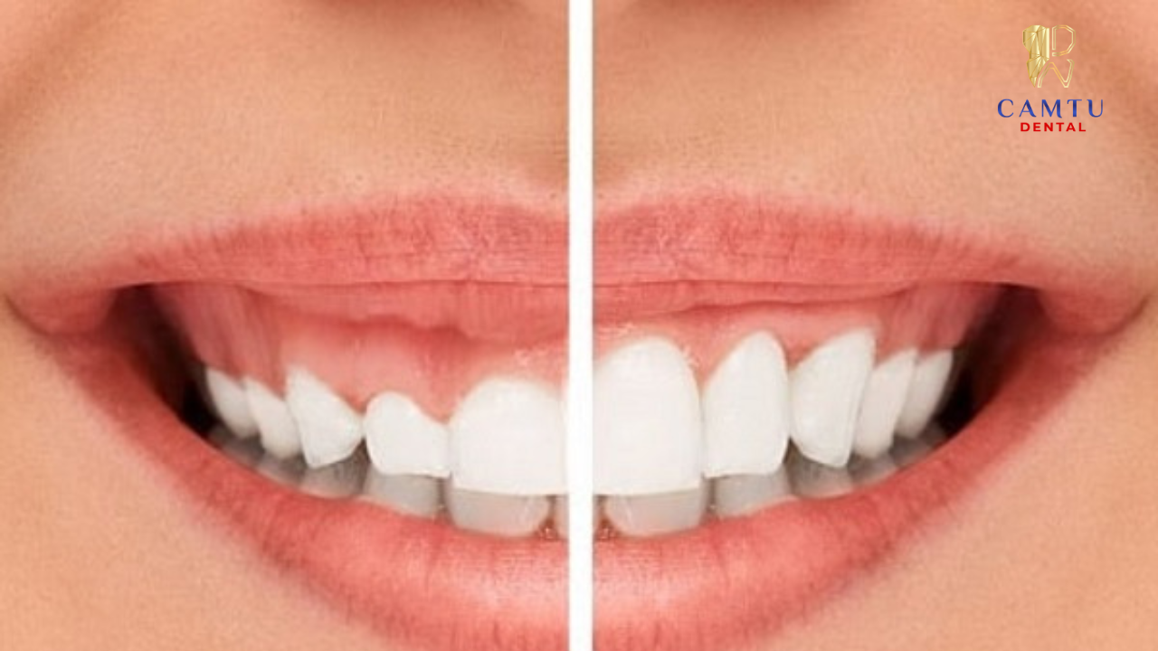 Cắt lợi thẩm mỹ là phương pháp loại bỏ những mô nướu dư thừa