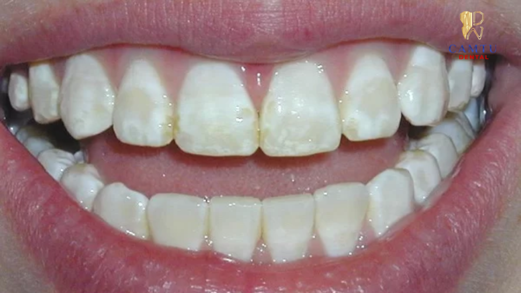 Hiện tượng răng không giữ được màu trắng