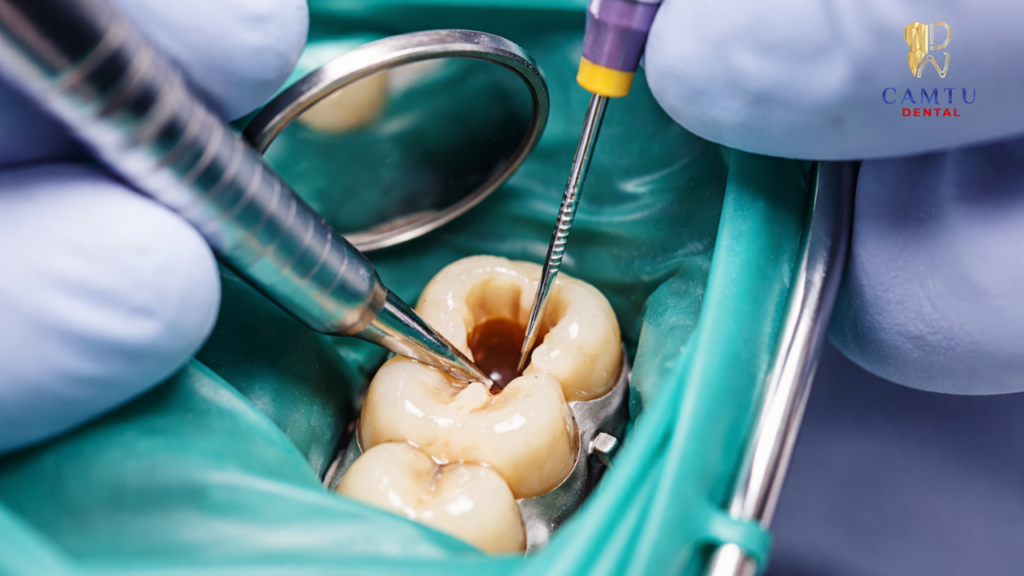 Lấy tủy răng là gì?