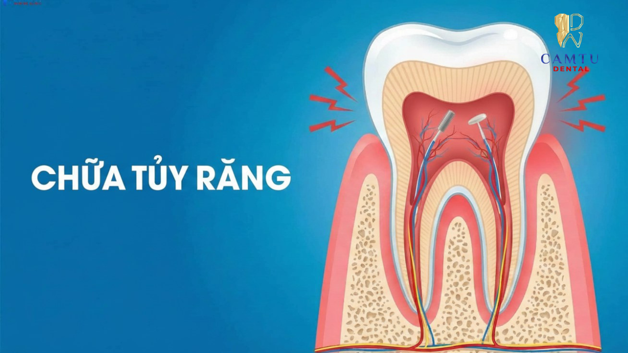 Chữa tủy răng là như thế nào?