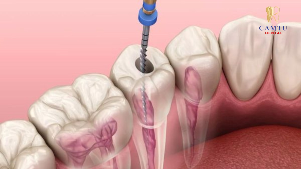 Điều trị tuỷ răng sẽ không đau nếu được điều trị đúng cách