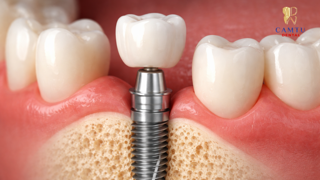 Cấu tạo của trụ implant cho răng