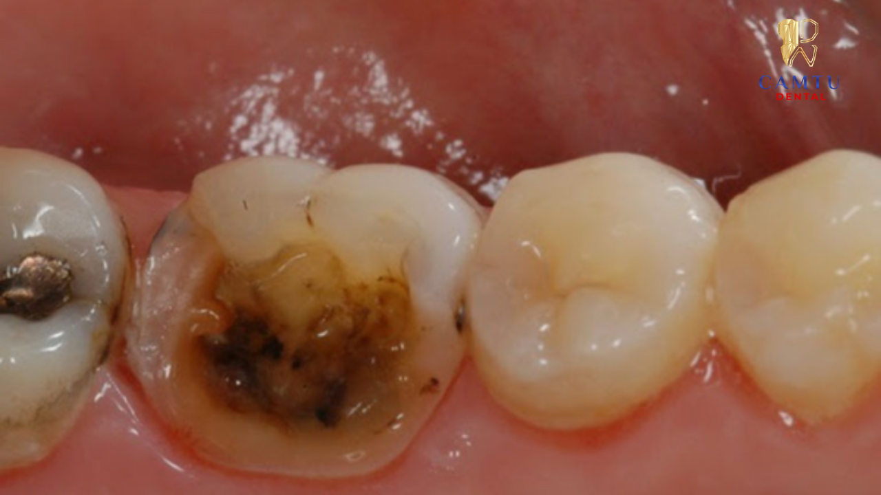 Răng nứt hoặc chấn thương