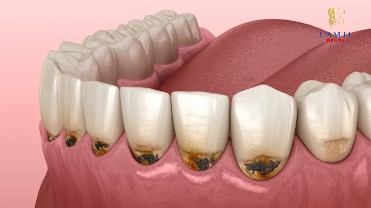 Mòn cổ chân răng là hiện tượng mô cứng của răng dần mất đi