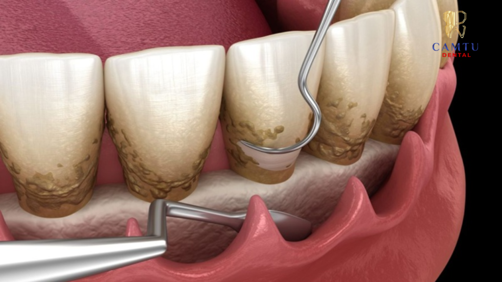 Nạo túi nha chu giúp loại bỏ vi khuẩn gây viêm nha chu