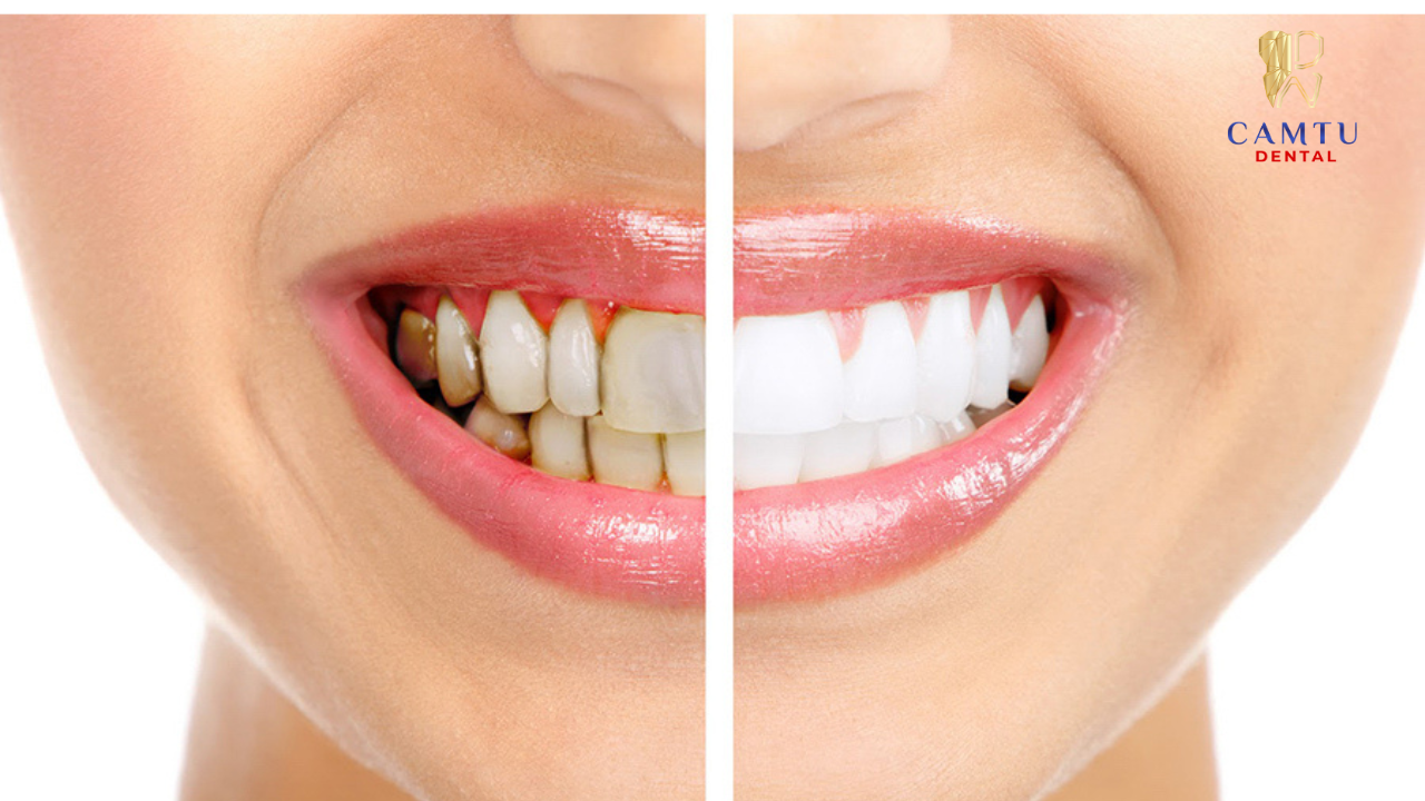 Tẩy trắng răng là gì?