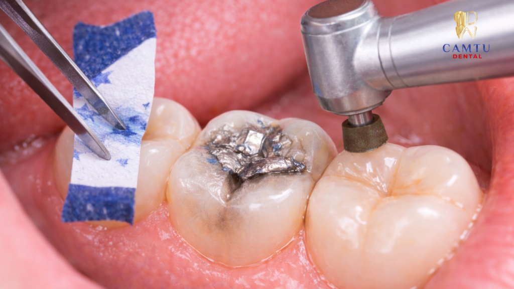 Điều chỉnh khớp cắn