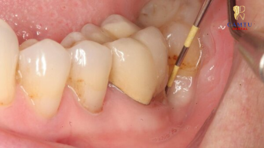 Khó chịu khi nhai và vệ sinh là dấu hiệu bạn nên đi khám răng