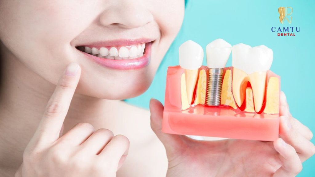 Giải pháp cấy ghép implant hiệu quả