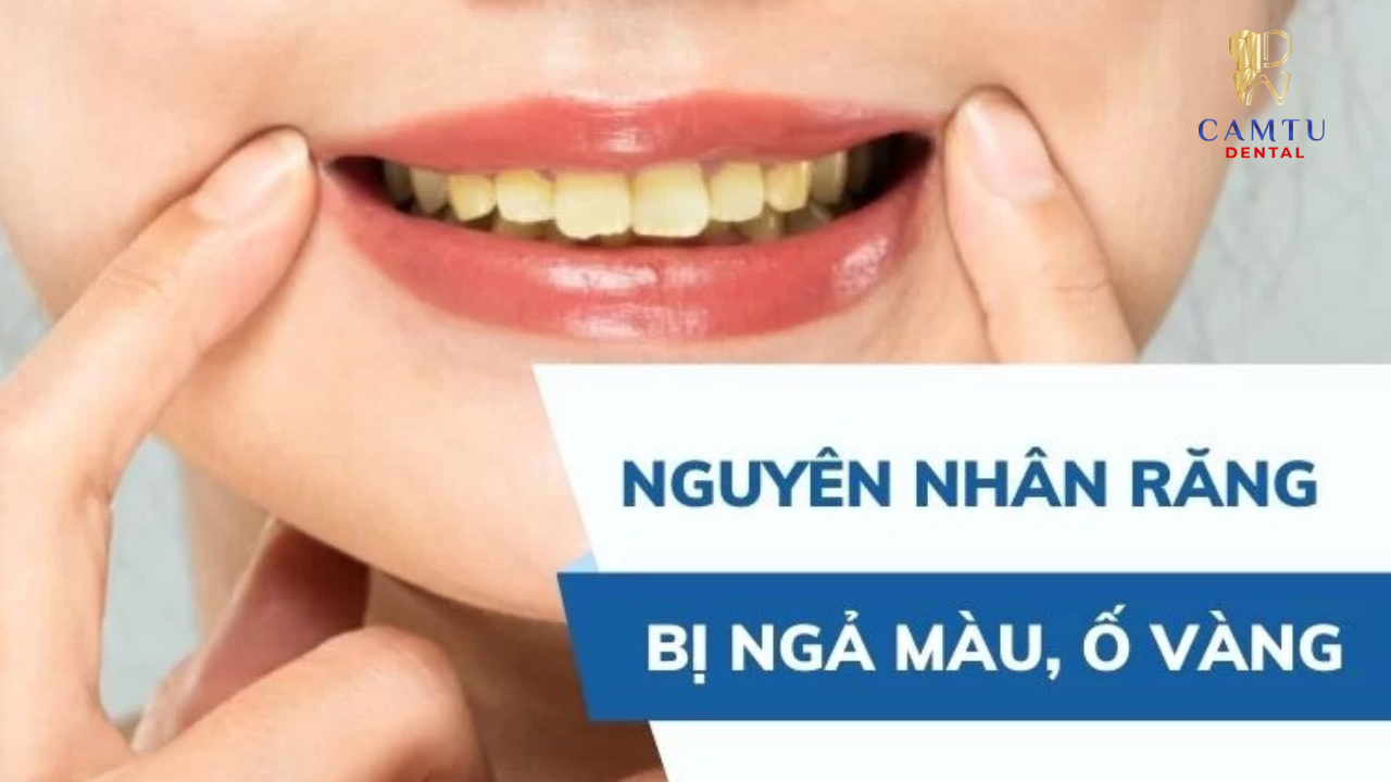 Nguyên nhân khiến răng bị xỉn màu