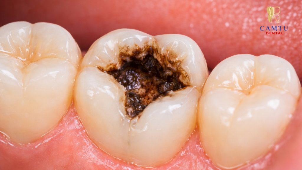 Răng bị sâu mức độ vừa hoặc lớn