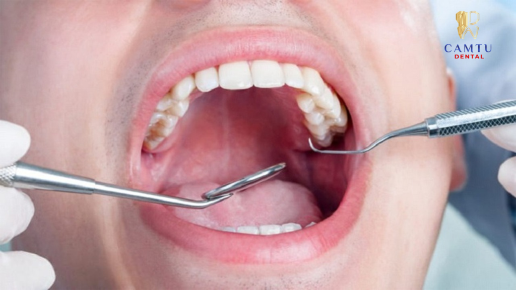 Nhổ răng số 8 đúng kỹ thuật, không gây nguy hiểm