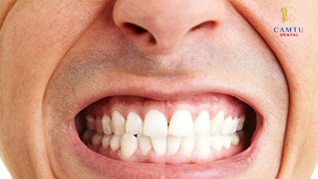Thói quen xấu nghiến răng tạo ra lực ép lớn