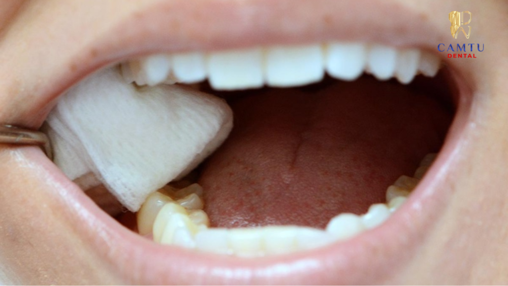 Những thay đổi sau khi vừa nhổ răng