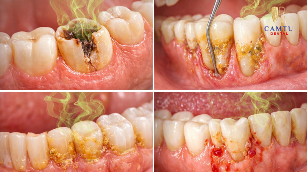 Các nguyên nhân gây ra hôi răng miệng