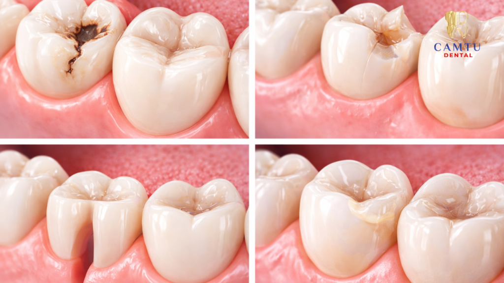 Trường hợp nên trám răng composite