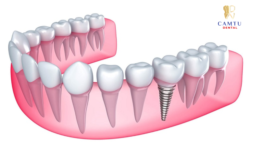 Trồng răng implant là gì?