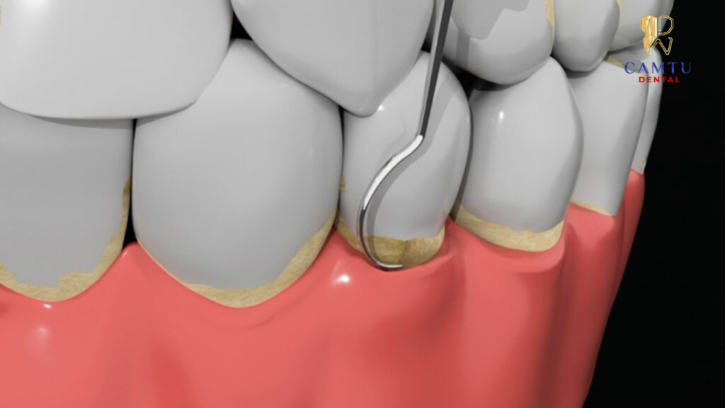 Khi nạo túi nha chu phải có chỉ định của các bác sĩ