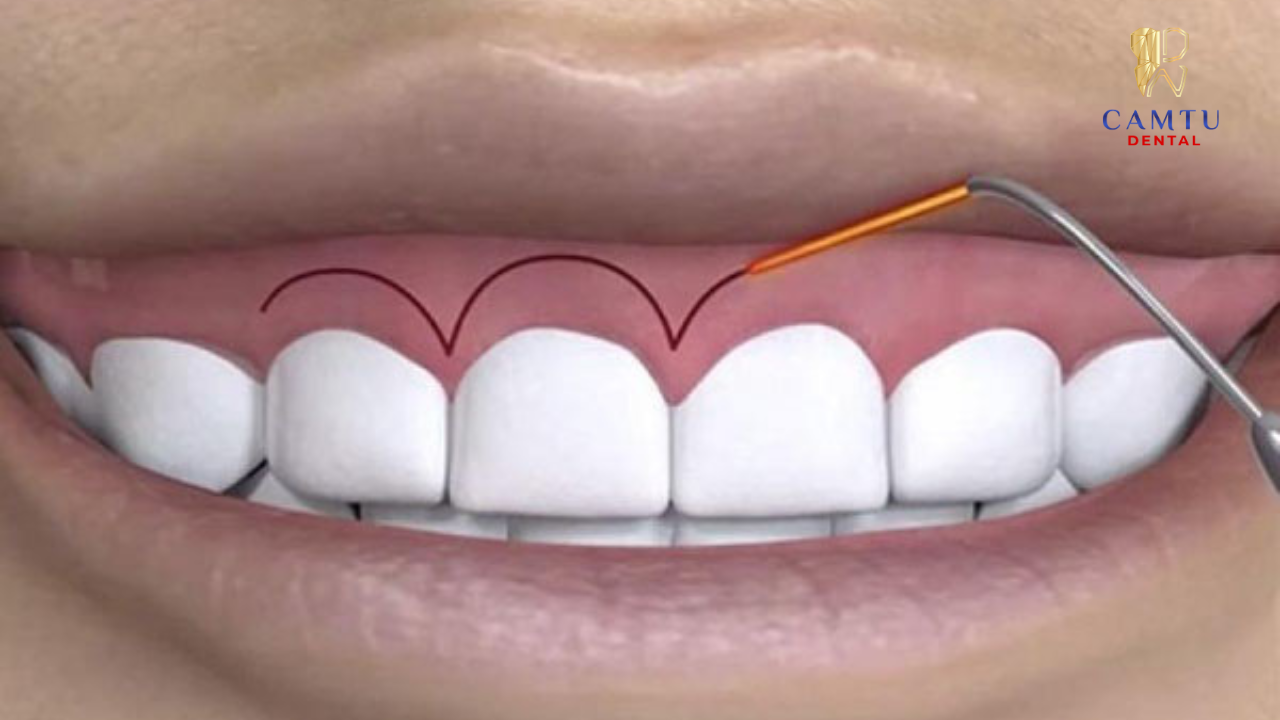 Cười hở lợi, thẩm mỹ kém khi cười