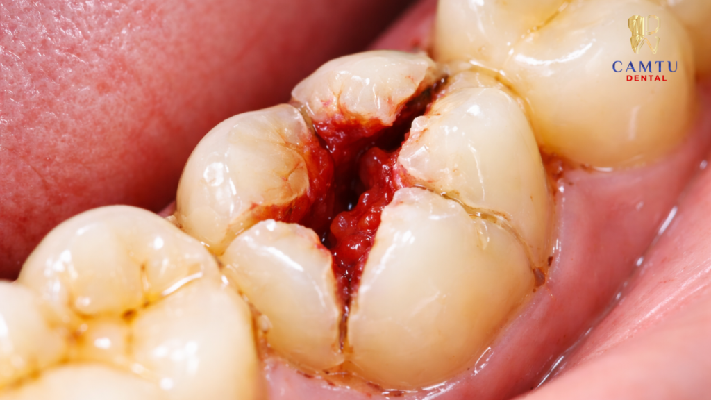 Răng bị nứt, vỡ làm lộ tủy