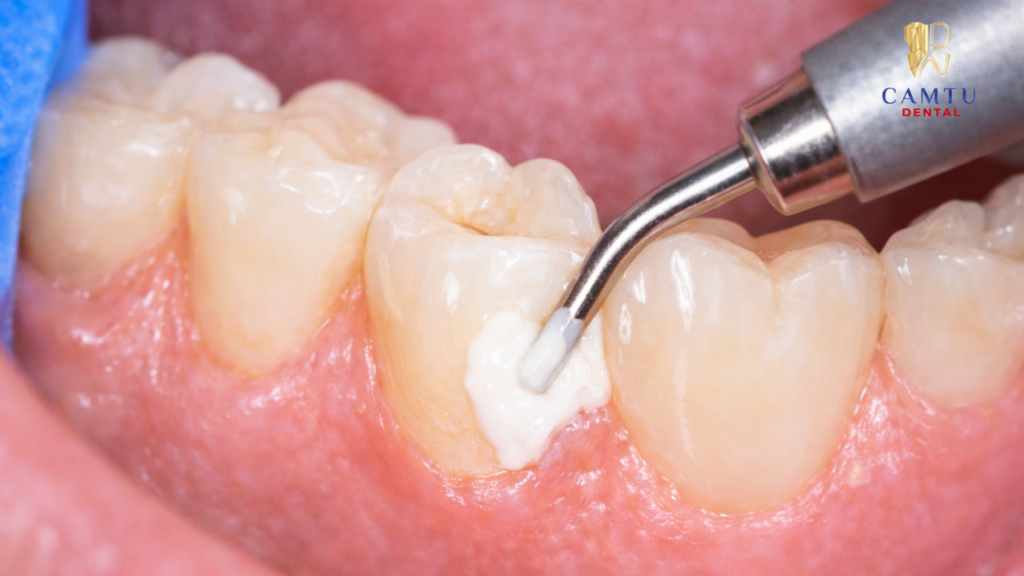 Phục hồi cổ răng hoặc vùng chân răng