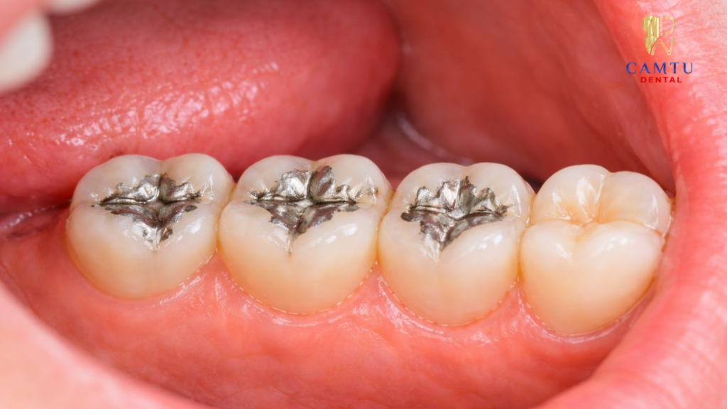 Vị trí trám không yêu cầu thẩm mỹ cao