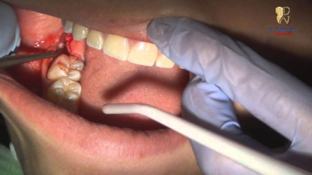 Gây tê để nhổ răng số 8 