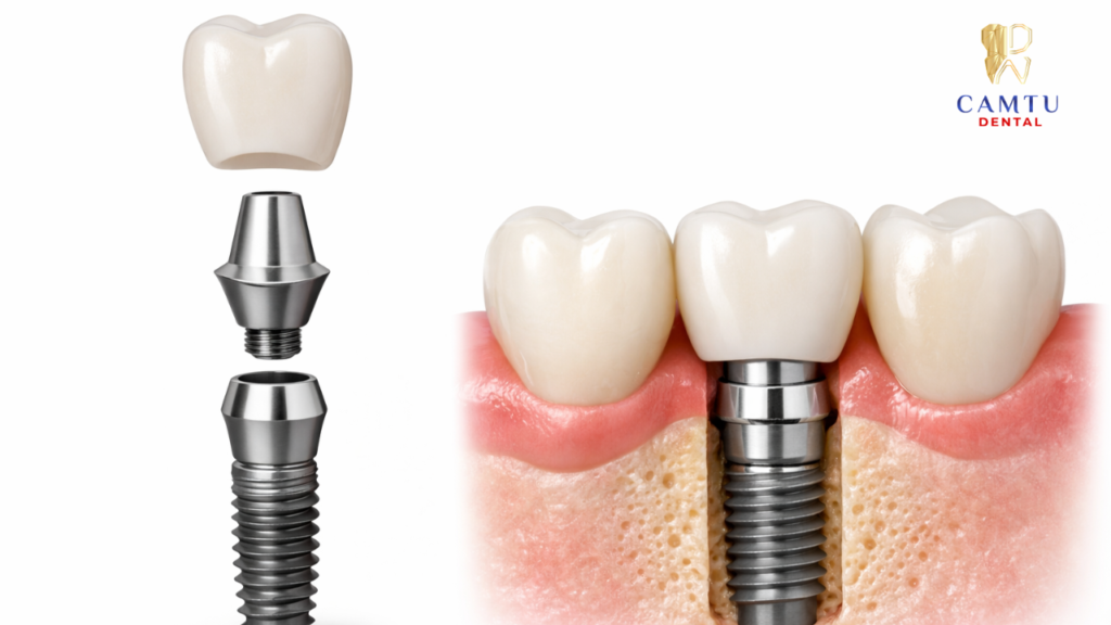 Khớp nối implant chi tiết