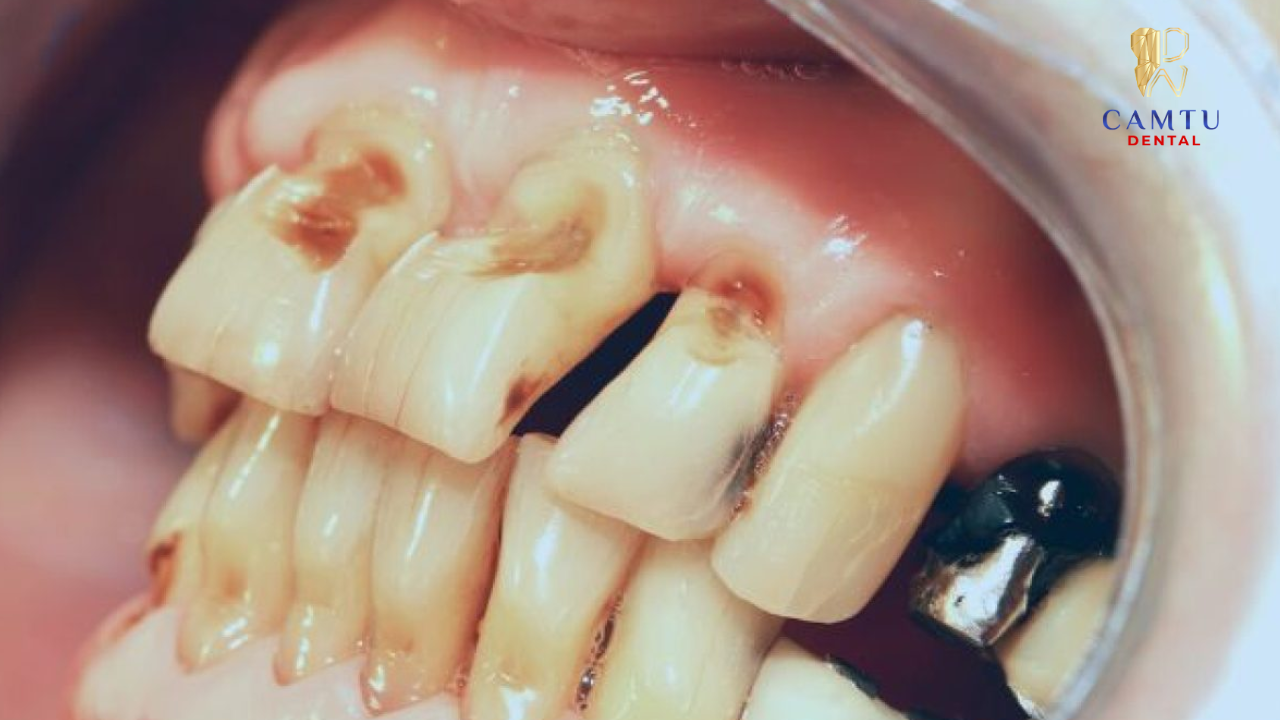 Ăn nhai không đều hoặc cắn lệnh sẽ ảnh hưởng đến men răng 