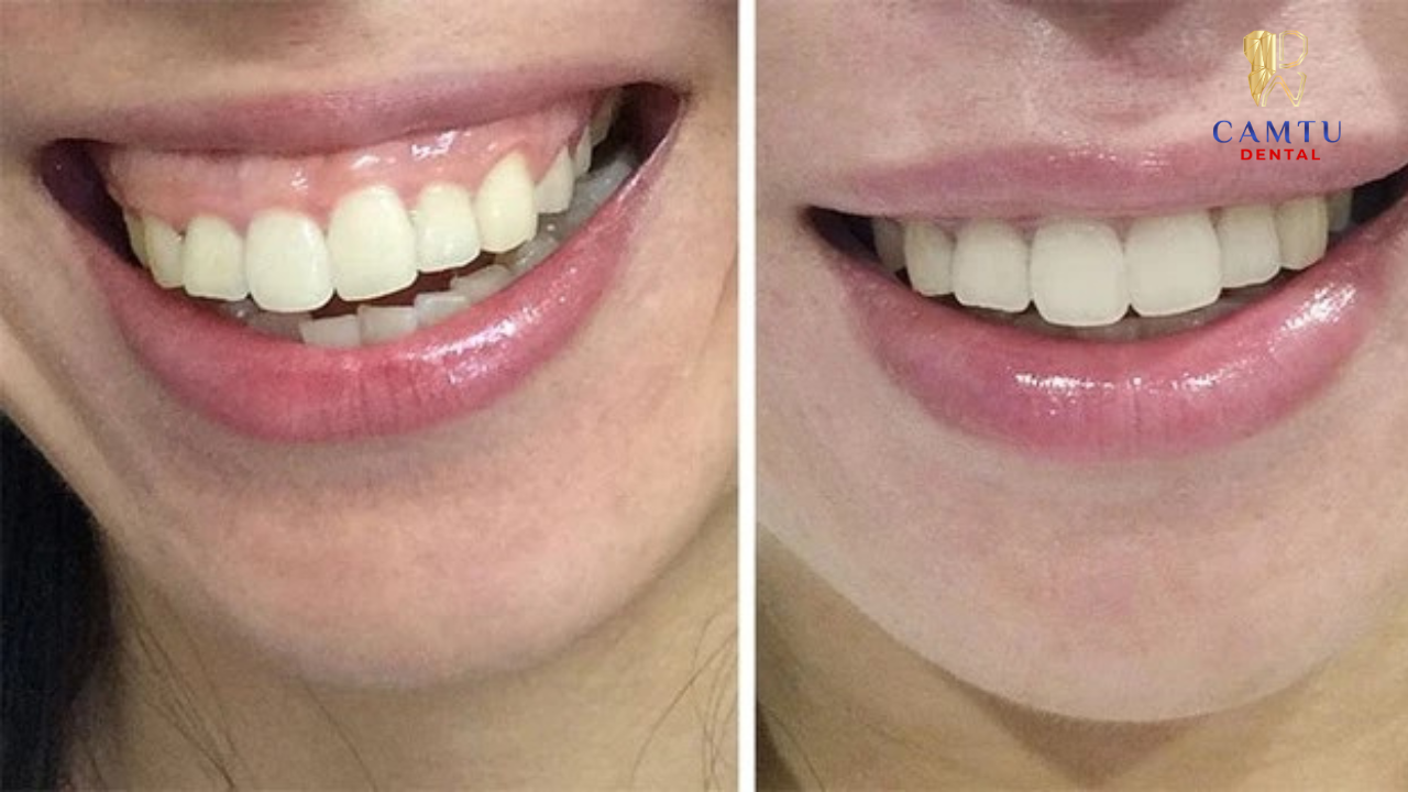 Lợi che phủ nhiều làm răng trông ngắn