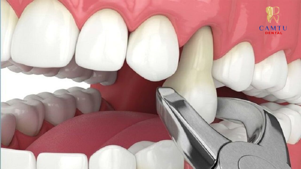 Nhổ răng số 4 đúng cách giúp giảm đau