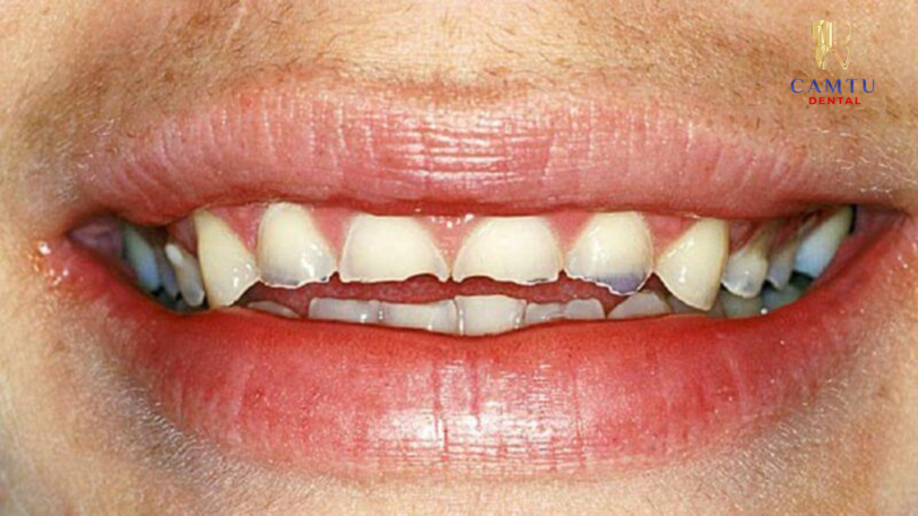 Nguyên nhân gây ra răng bị mòn