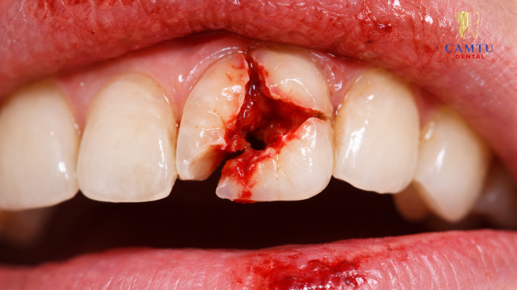 Chấn thương răng làm tổn thương tủy