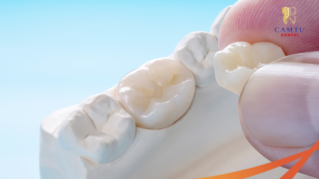 Mão răng sứ (Crown)