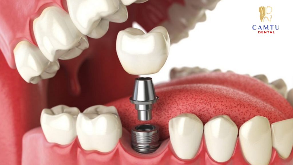Cấy ghép trụ implant