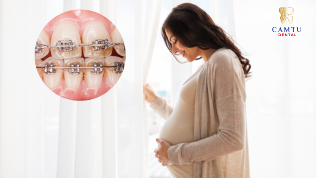 Có nên bắt đầu niềng răng khi đang mang thai không?