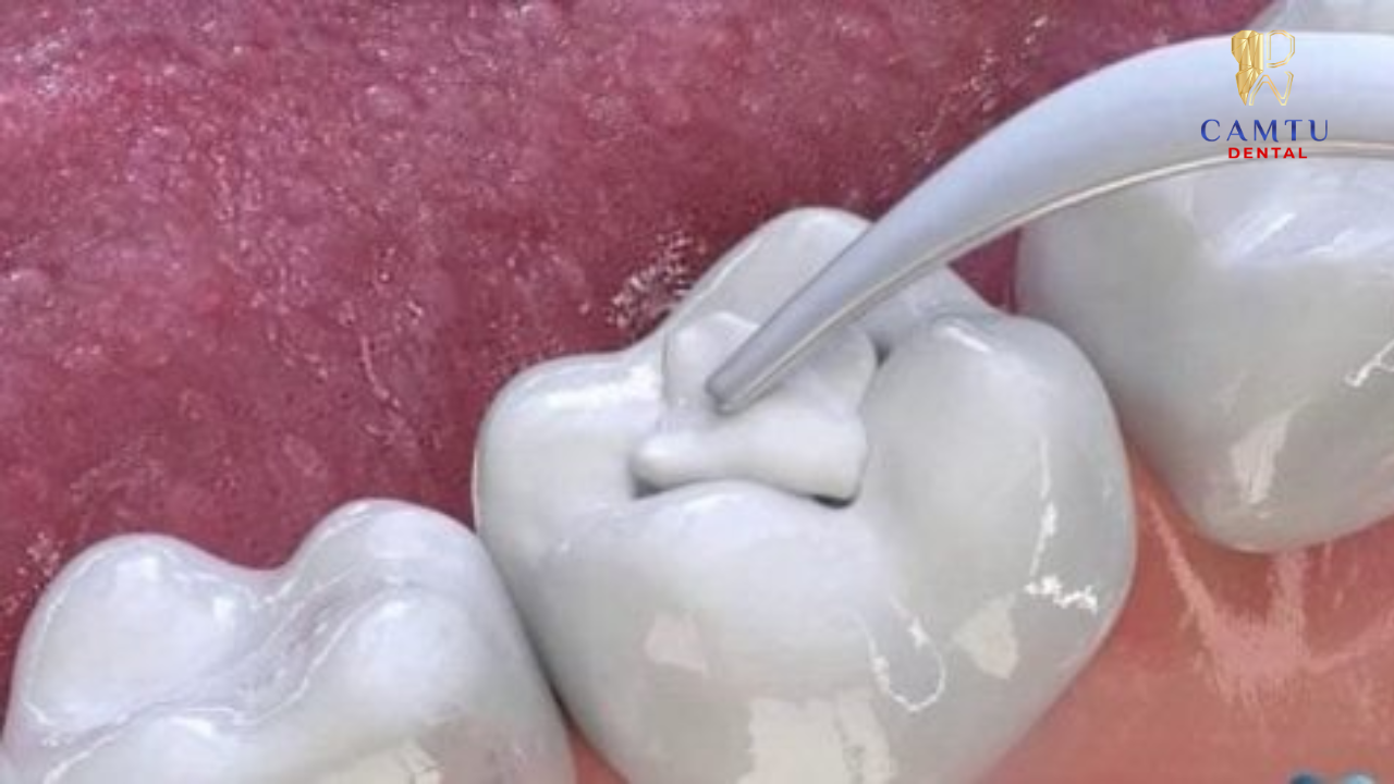 Khi điều trị tuỷ răng sẽ được gây tê nên ít có cảm giác đau