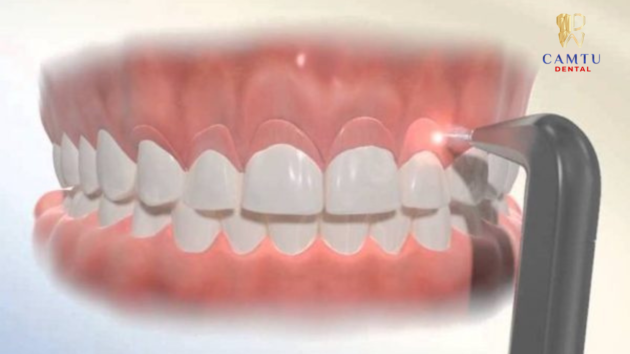 Cắt lợi để phục hình sứ