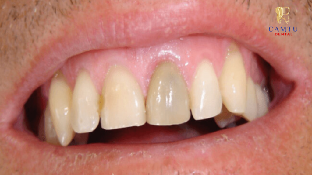 Dấu hiệu nhận biết răng đã bị đổi màu