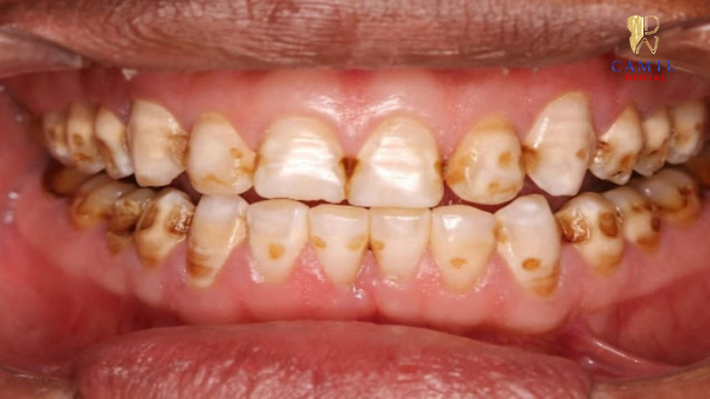 Đốm trắng hoặc đen là dấu hiệu sâu răng