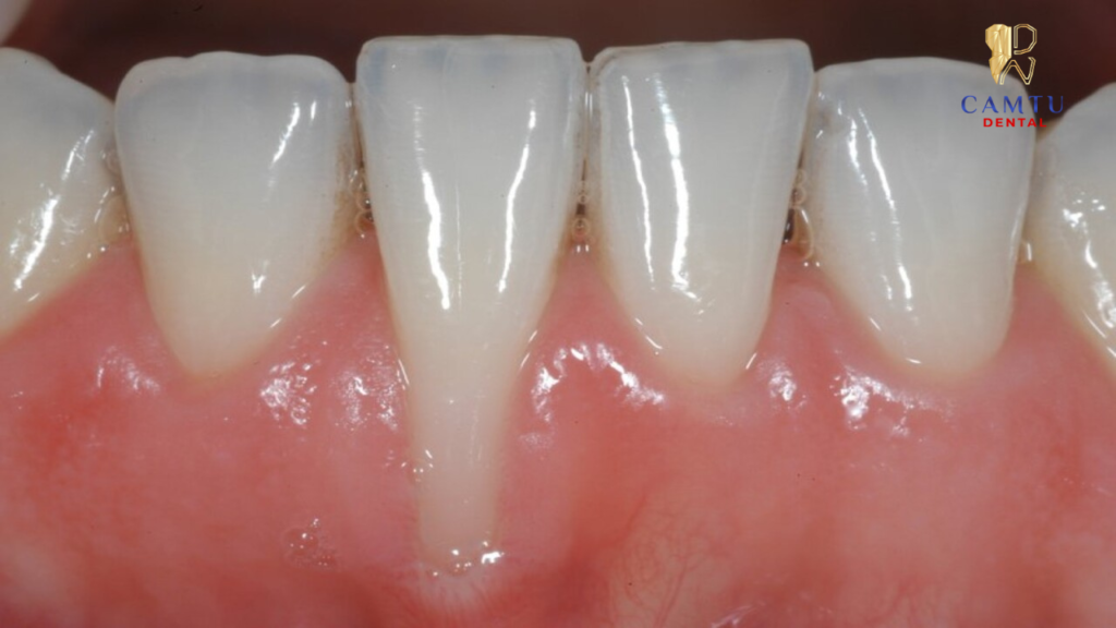 Phần nướu, lợi bị tụt khiến chân răng lộ ra