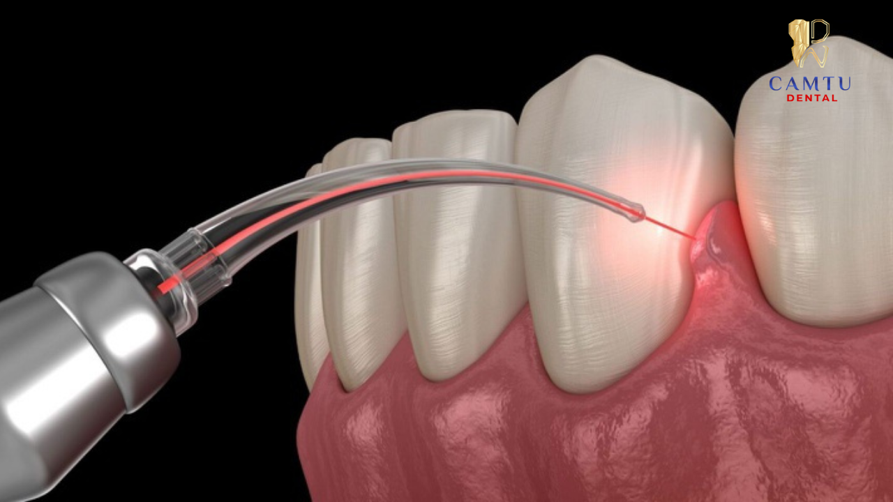 Cắt lợi để phục hình sứ
