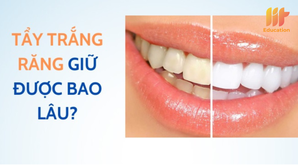 Tẩy trắng răng giữ được bao lâu?