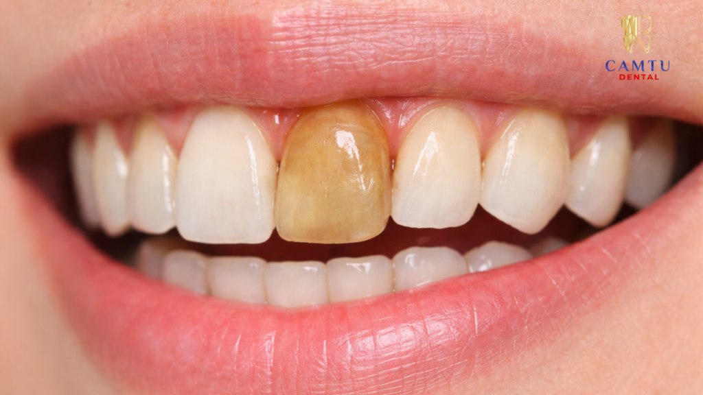 Răng đổi màu sẫm hơn