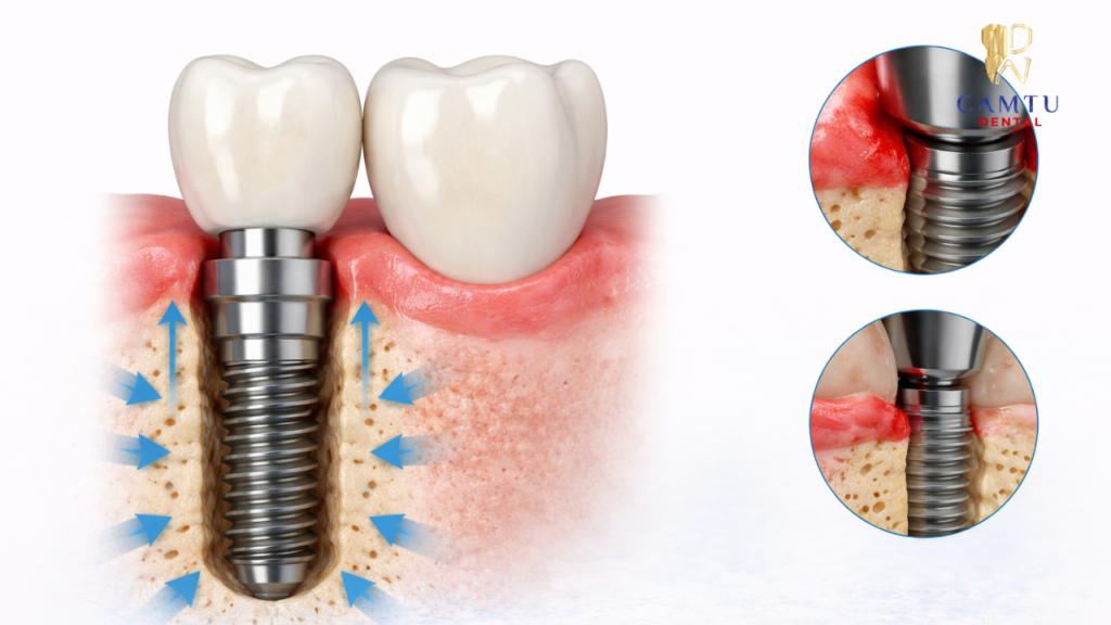 Chỉnh hình cấy ghép răng chi tiết