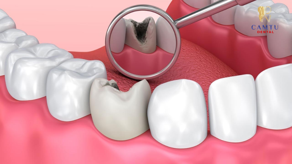 Vệ sinh và loại bỏ mô răng bị sâu