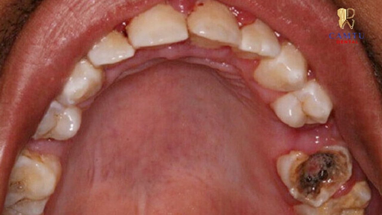 Hội miệng, răng sẫm màu 